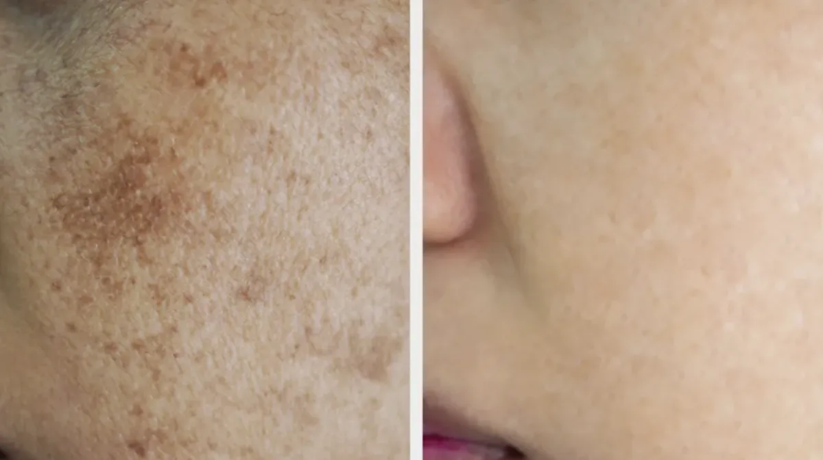 Q switch Laser at Dr. Tupe's Clinic