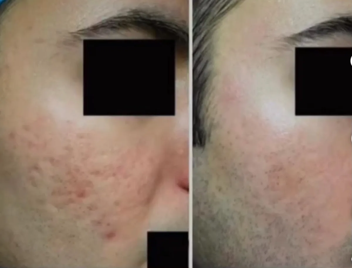 Acne scar treatment at Dr. Tupe's Clinic