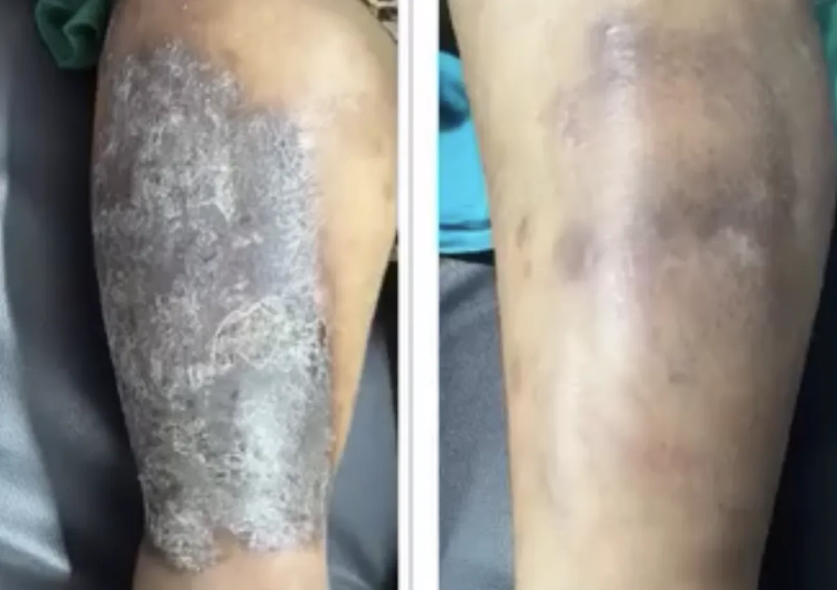 Eczema treatment at Dr. Tupe's Clinic