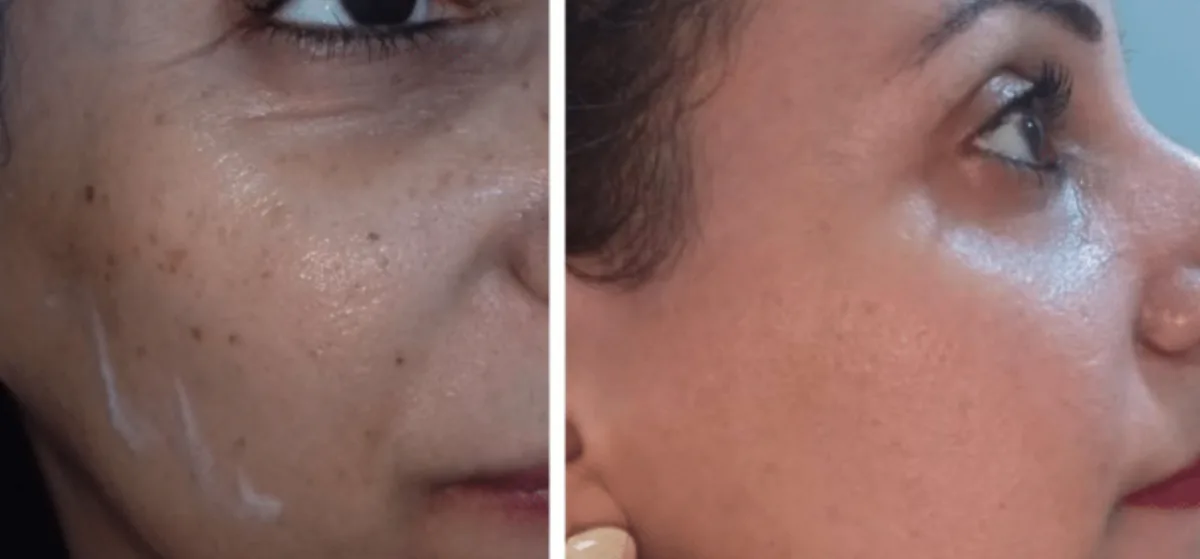Freckles removal at Dr. Tupe's Clinic